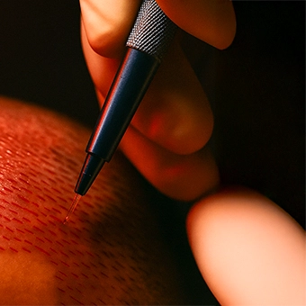 Hair Transplant with FUE Technique